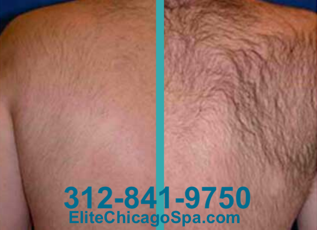 Bikini Laser Hair Removal in Chicago - Img 1