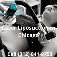 Laser Liposuction in Chicago...